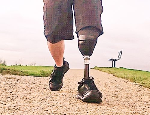 Person walking on a path with a prosthetic leg, wearing shorts and black shoes.